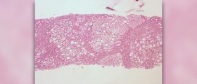 Signs and symptoms of alcoholic liver disease