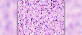 Signs and symptoms of fibroid tumors