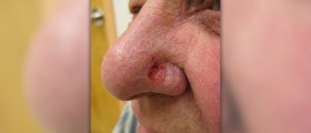 Signs of basal cell carcinoma