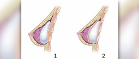 Silicone breast implants