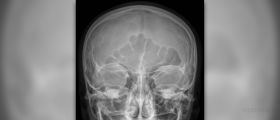 Sinus drainage review