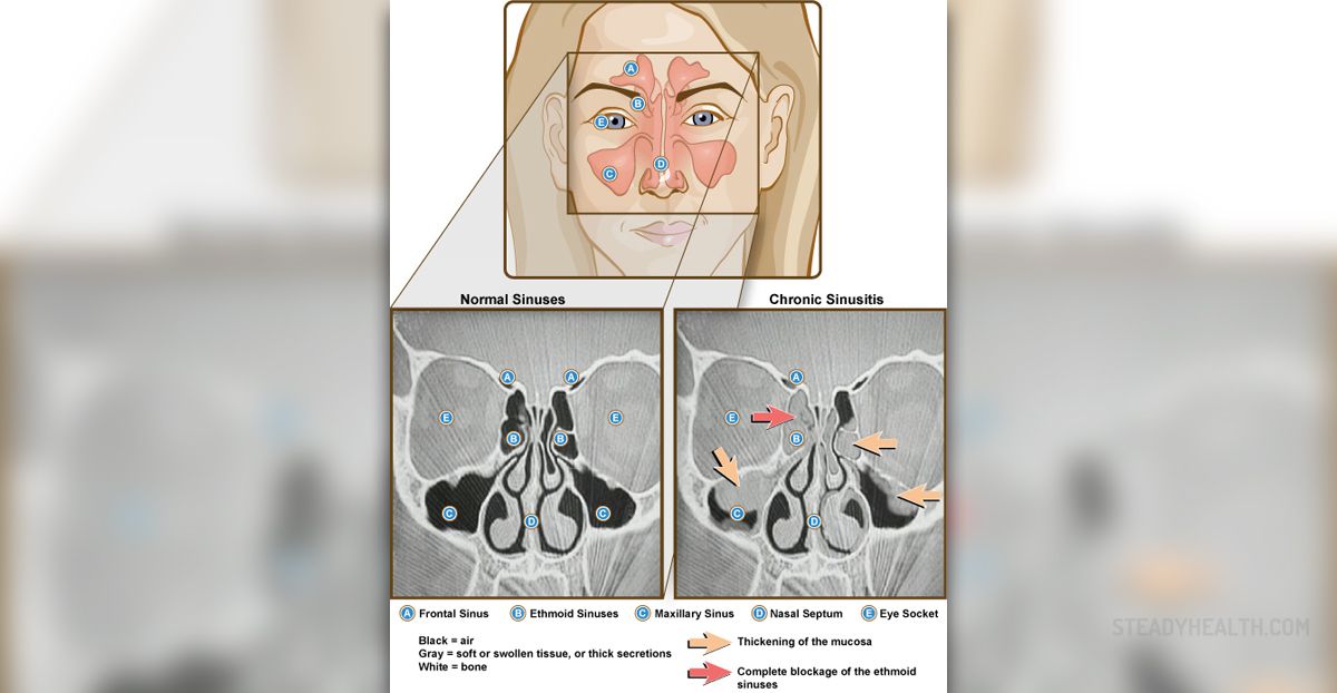 Complications Of Sinusitis General Center