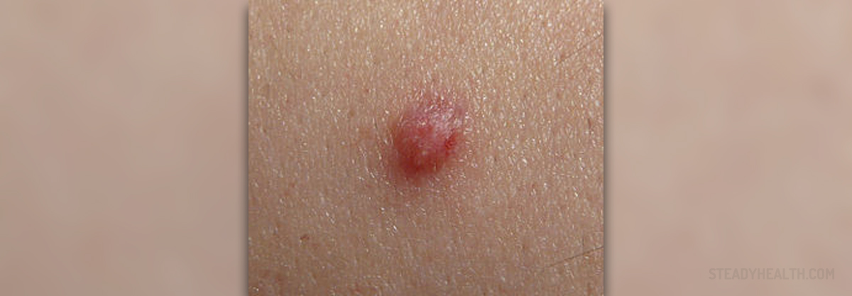 Red Itchy Bumps Skin And Hair Problems Articles Body And Health
