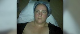 Skin discoloration in melasma