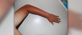 Skin rash from sun