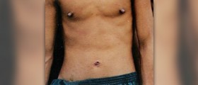 Skin tag removal at home - home remedy for skin tags