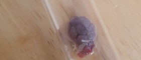 Know more about vaginal skin tags