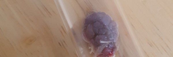Know more about vaginal skin tags