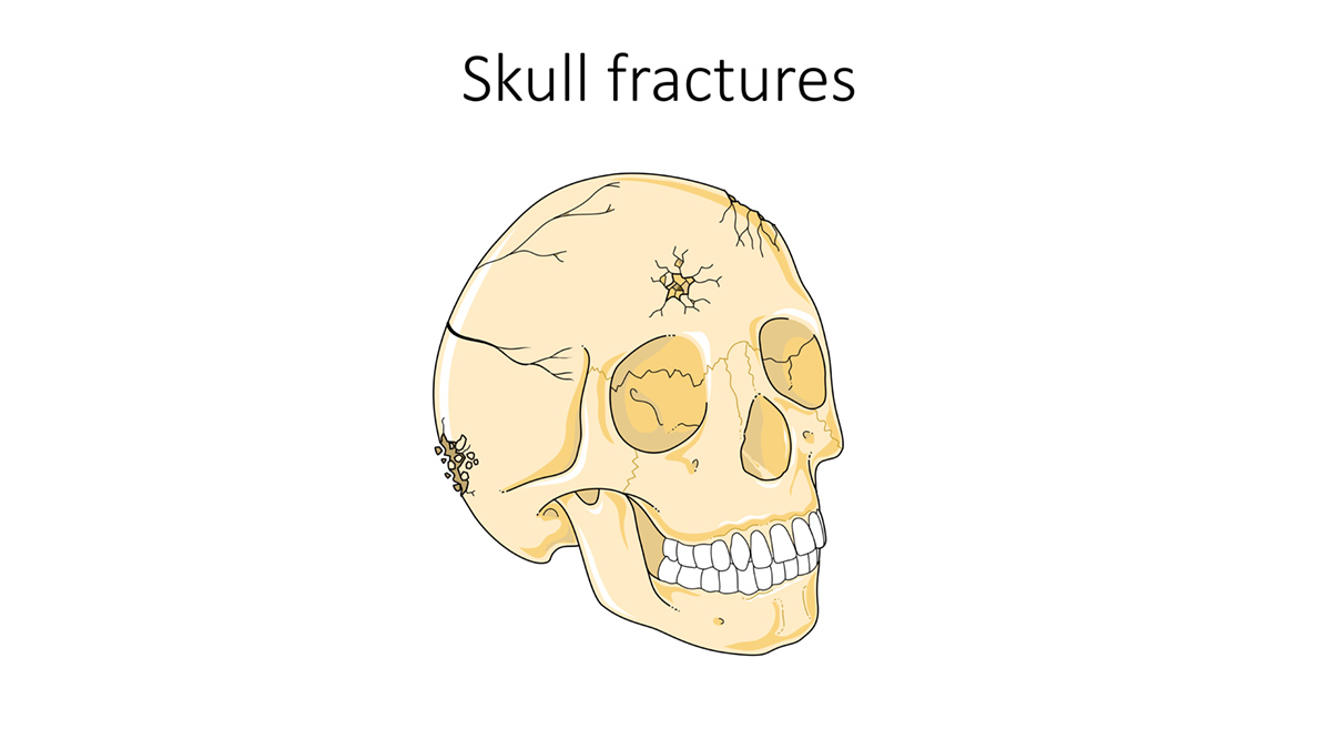 skull fracture signs