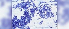 Small cell lung cancer symptoms
