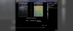 Soft tissue damage