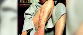 Some alternative approaches to dealing with psoriasis