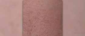 Some skin parasites can ruin your sex life