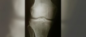Sore knee treatment