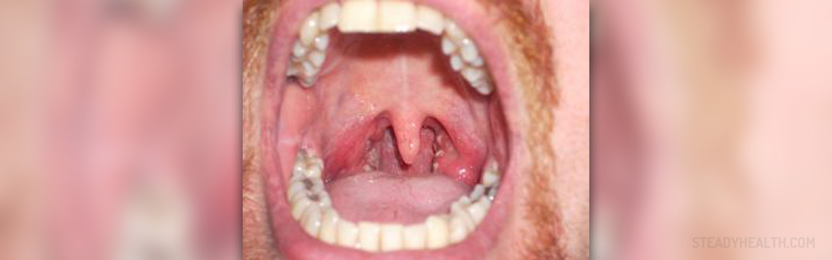 Sore throat and swollen glands | Ear, Nose, Throat, and Dental problems