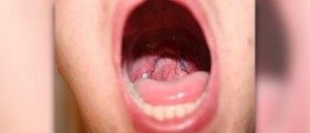 Sore throat during pregnancy