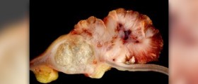 Spastic colon diet