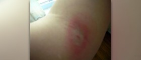 Spider bite treatment