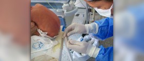 Spinal muscular atrophy - SMA