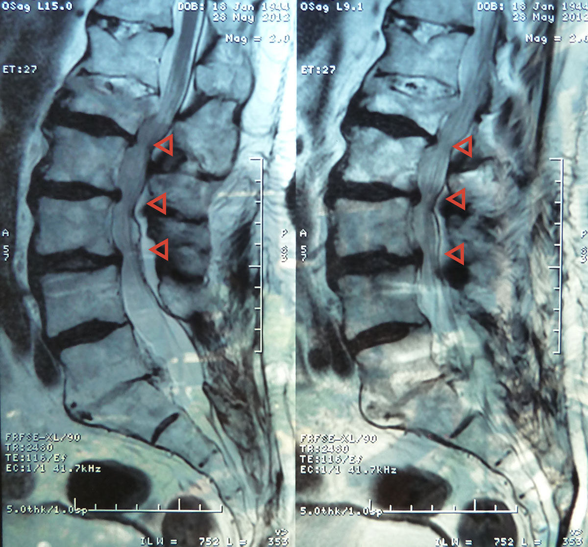 Spinal stenosis imaging with MRI | Nervous System Disorders and