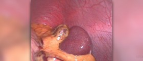 Spleen pain causes