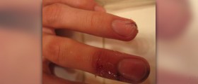 Splitting nails facts
