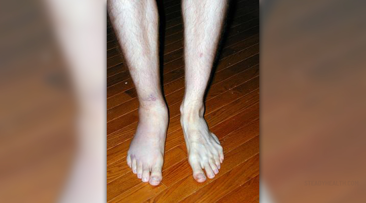 Sprained Ankle Causes And Symptoms General Center SteadyHealthcom