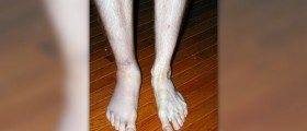 Sprained ankle causes and symptoms