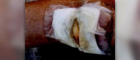 Staph blood infection
