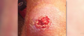 Staph infection after surgery
