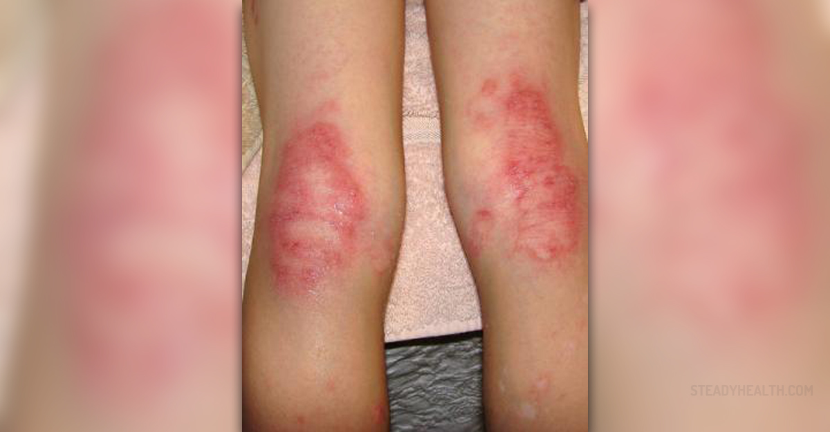 107-symptoms-of-a-staph-infection-on-your-skin