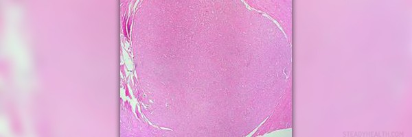 Steps for reducing uterine prolapse