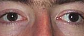 Strabismus treatment review