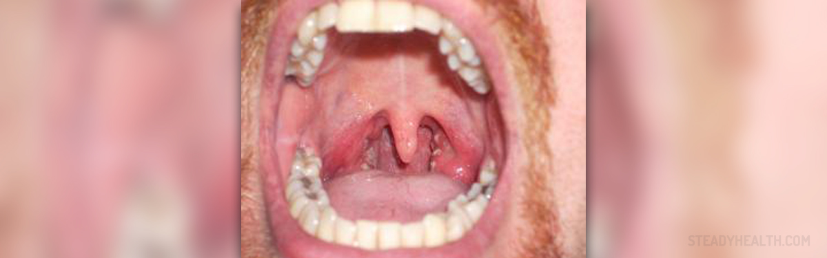 Strep Throat In Adults Respiratory Tract Disorders And Diseases