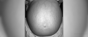 Stretch marks: prevention and treatment during pregnancy