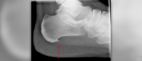Stretching exercises for plantar fasciitis