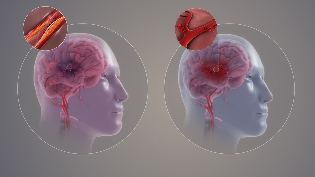 What causes stroke | General center | SteadyHealth.com