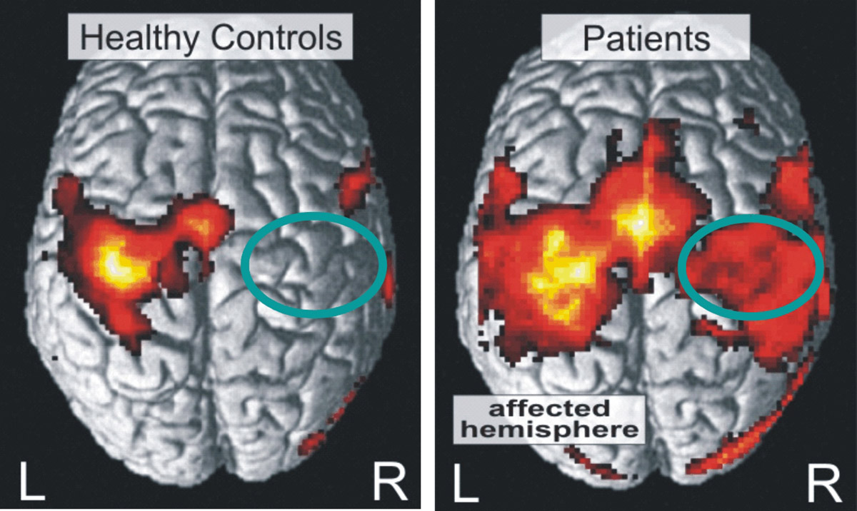 after effects of mini stroke