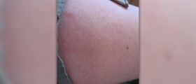 Sun poisoning rash