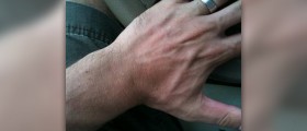 Sun poisoning symptoms, causes and treatment