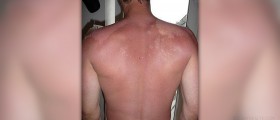 Sunburn symptoms and treatment