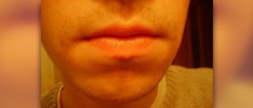 Sunburned lips treatment