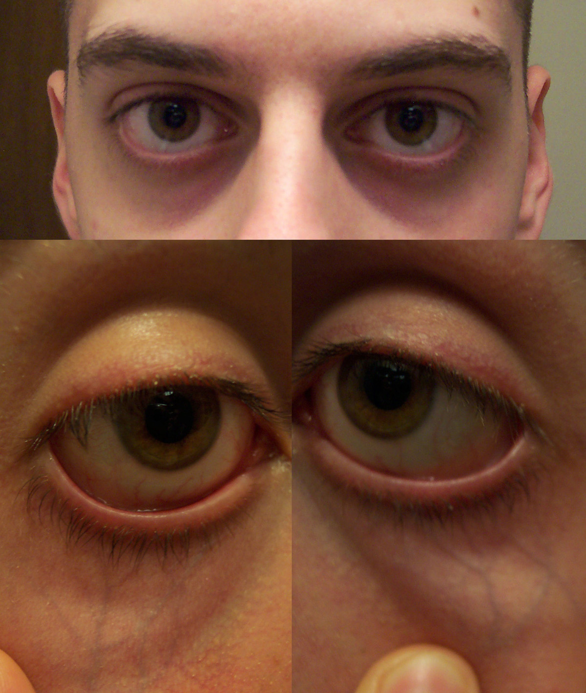 Surgery for sunken eyes | General center | SteadyHealth.com