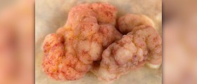 Surgery for colitis