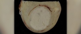 Surgery for fibroids