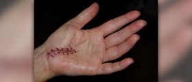 Surgery for finger fusion