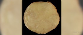 Surgery for lipoma