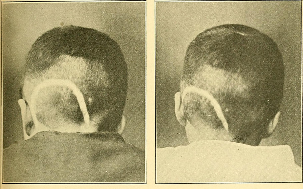 Surgery for nystagmus | General center | SteadyHealth.com