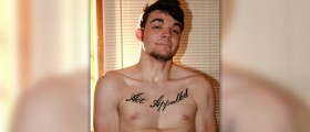 Surgery for pectus excavatum