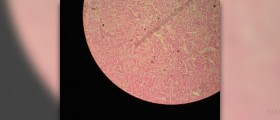 Surgery for pituitary tumor